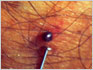 Nymphal Tick