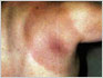 Lyme Disease Rash