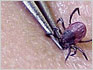 Remove Tick With A Tweezer