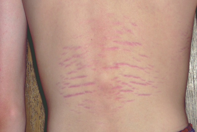 Bartonella Rash