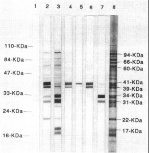 Western Blot test for lyme disease