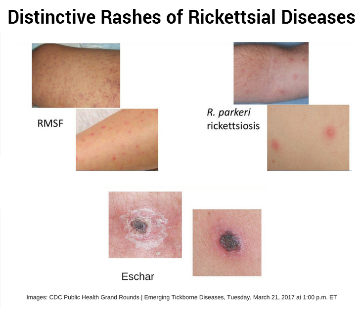 distinctive rashes of rikettsial diseases