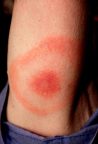 Early Lyme disease, people my develop a bulls-eye rash.