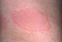 Early lyme disease patients may have a red difusse rash