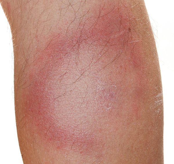 Erythema migrans rash