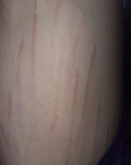 bartonella dermatological symptoms