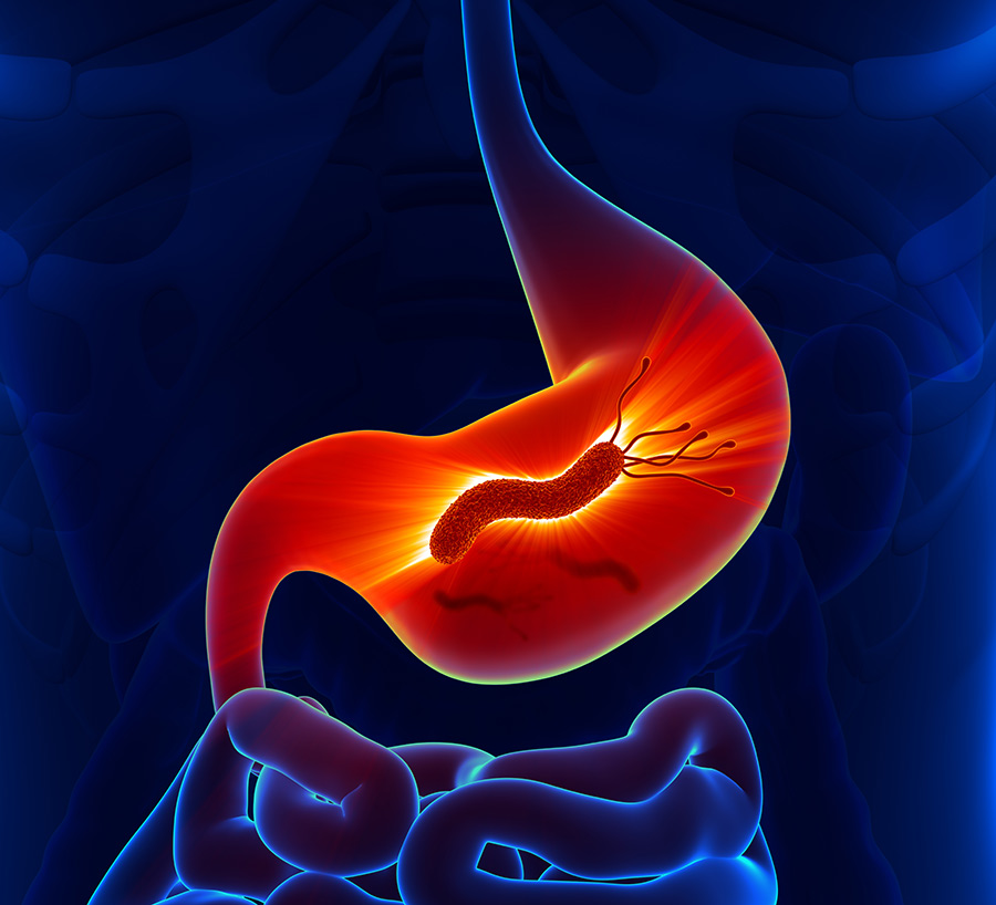 stomach ulcers caused by H. pylori