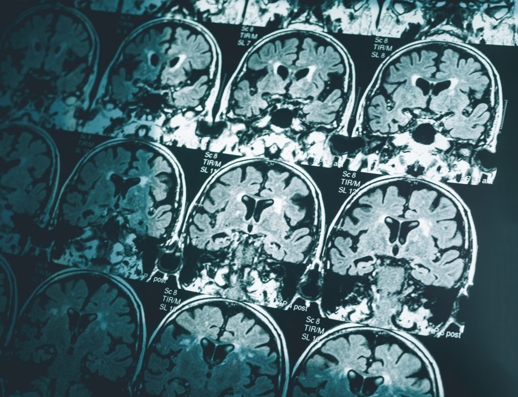 Alzheimers cure