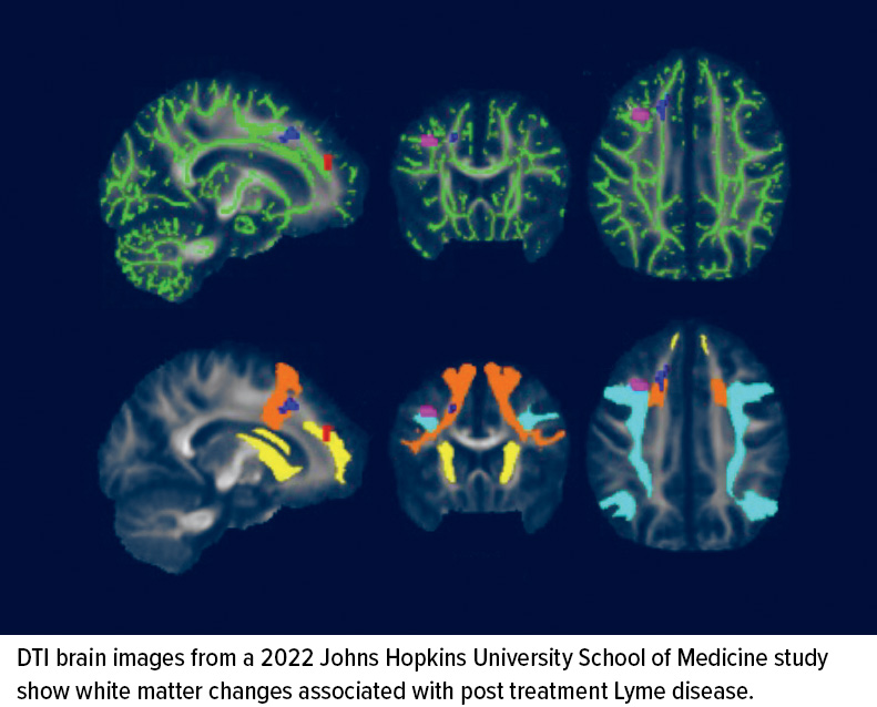 John Hopkins Lyme disease research