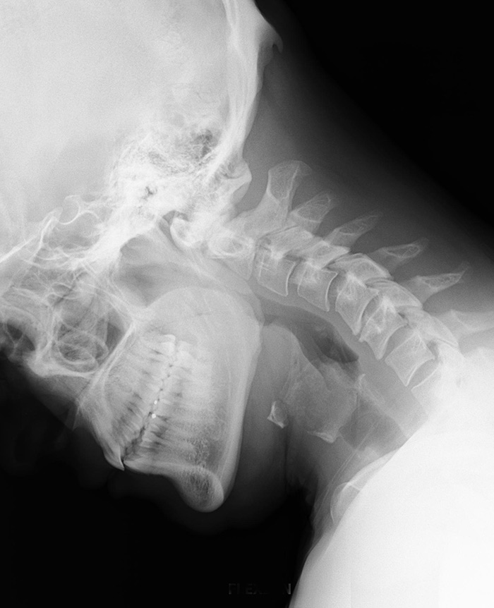 CCI is Craniocervical Instability