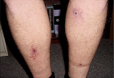 Figure 1: Inoculation eschars associated with the site of tick attachment in a patient infected with R. parkeri. (Photo courtesy of CDC)