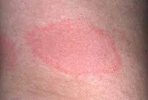 an image of an arm with a red difusse rash