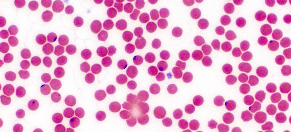 Babesia (blue spots) on red blood cells