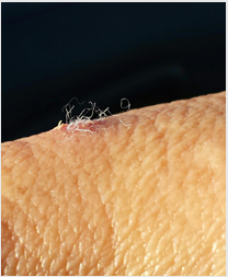 Morgellons on sale