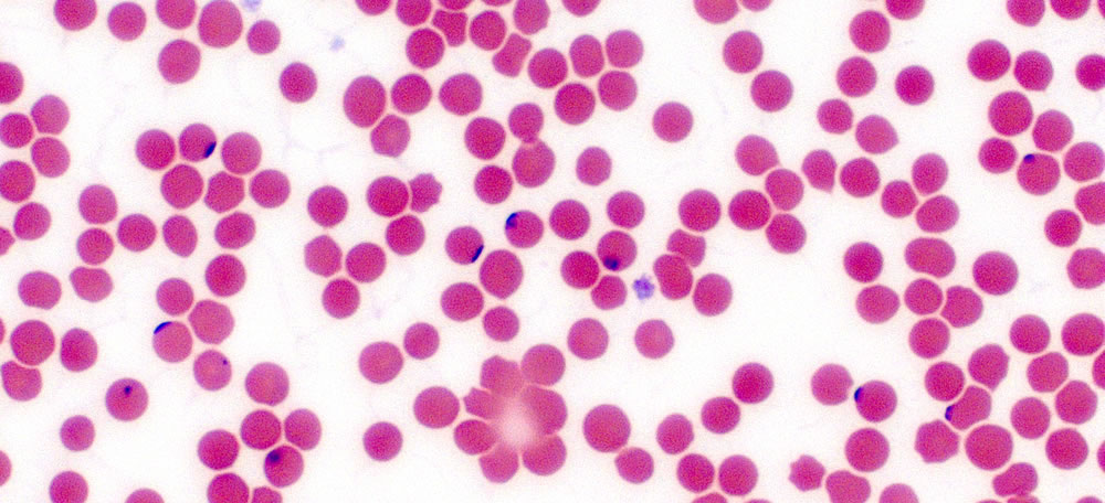 babesia