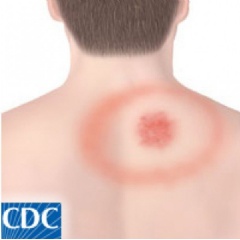 CDC Lyme rash