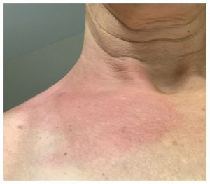 atypical lyme rash