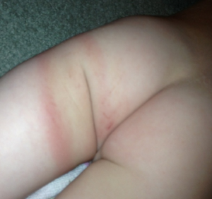 EM rash mistaken for bruise