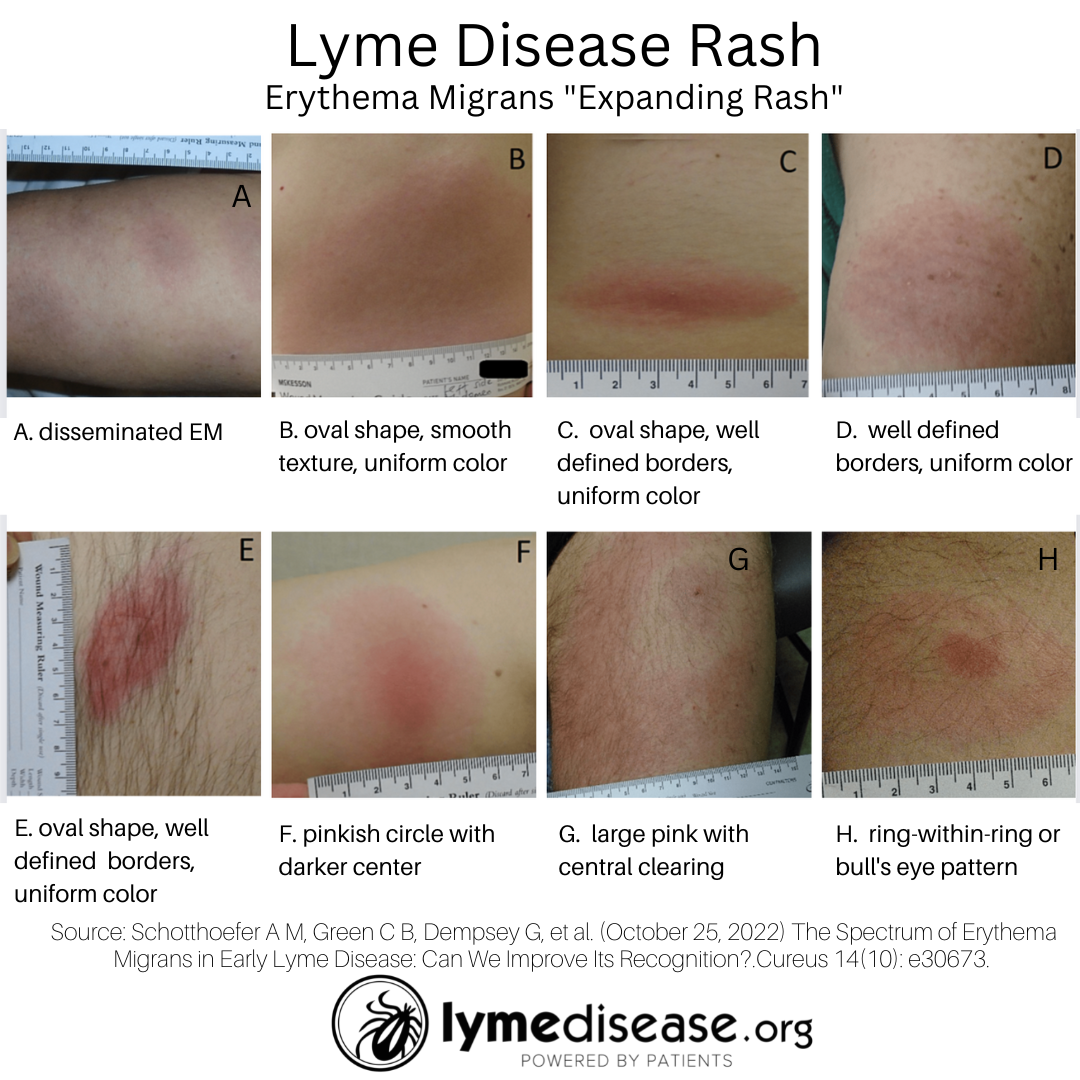 A Lyme Rash Doesnt Always Look Like A Bulls Eye Target