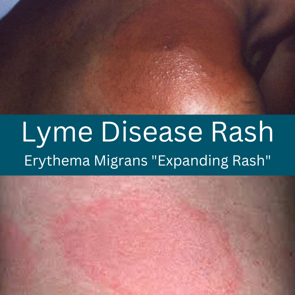 A Lyme Rash Doesnt Always Look Like A Bulls Eye Target