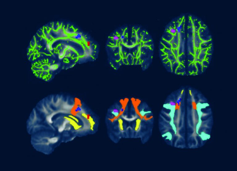 Advanced imaging shows Lymerelated brain fog is real